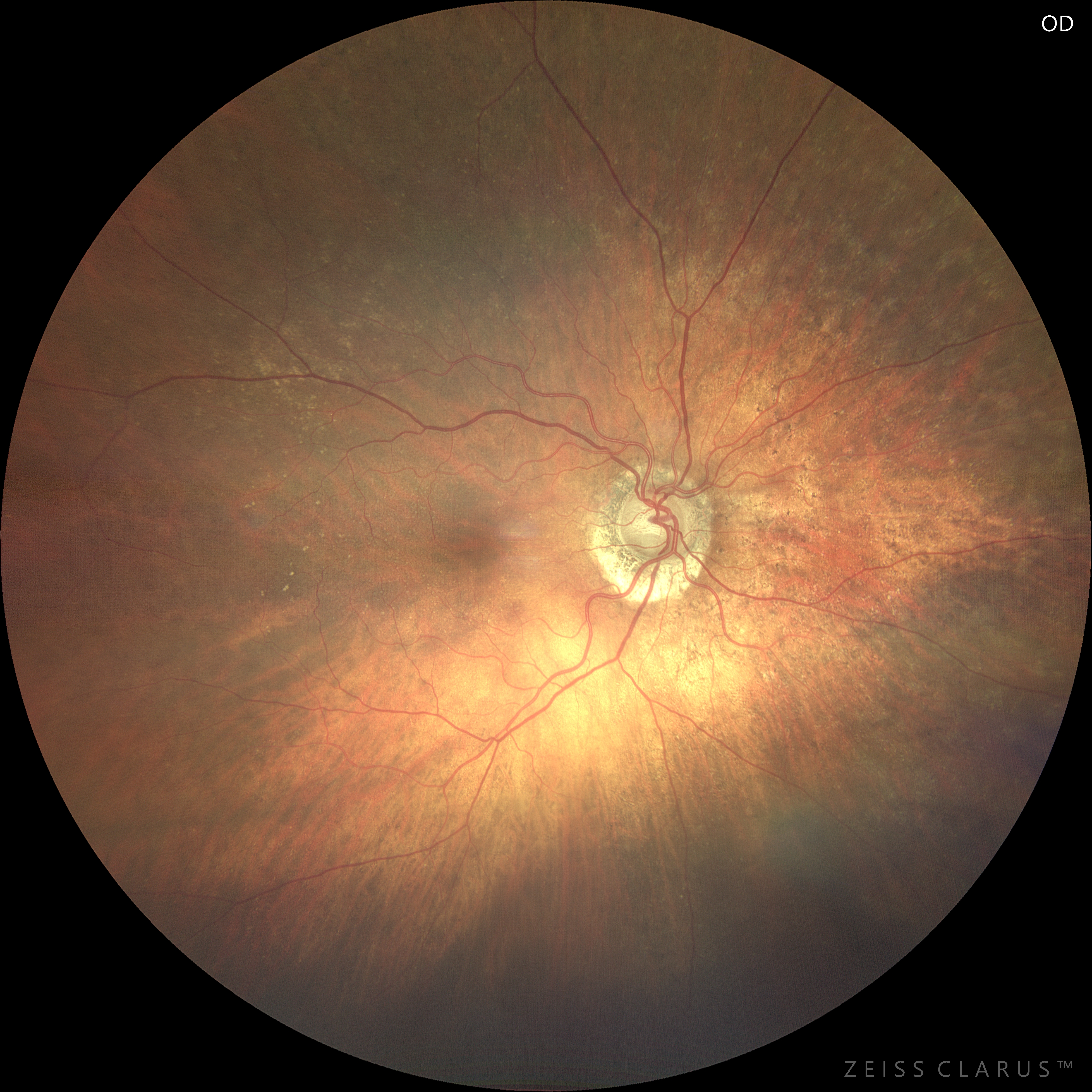 Glaucoma in paziente di 101 anni